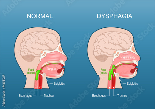 Dysphagia. Swallowing difficulty, aspiration