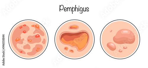 Pemphigus