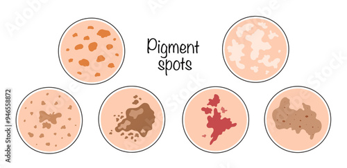 Pigment spots