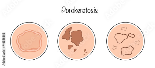 Porokeratosis