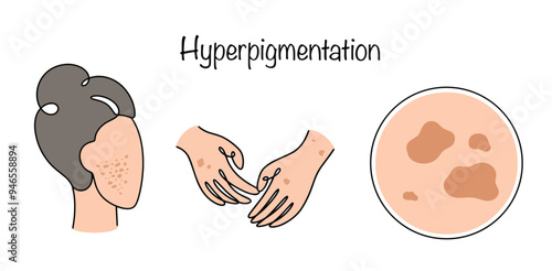 Hyperpigmentation