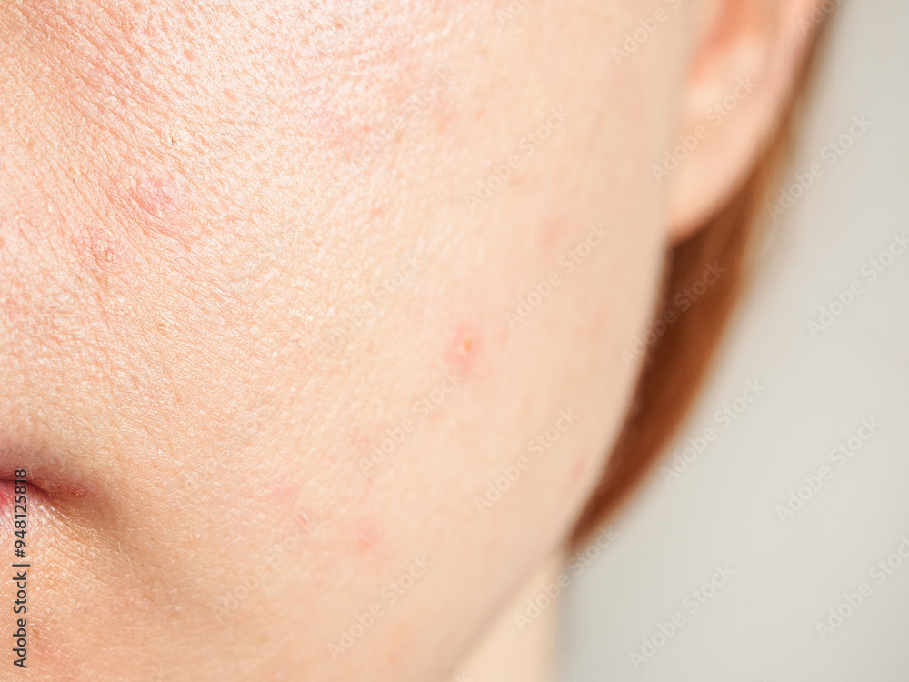Close-up of acne skin showing problems: inflammation and rashes reflecting the condition of the face Close-up of acne skin showing problems: inflammation and rashes reflecting the condition of the face