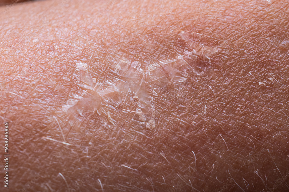 Fototapeta premium Close up of human skin peeling showing dry flakes