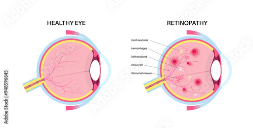 Diabetes related retinopathy