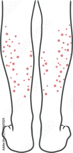肌荒れ（ブツブツ）している女性のふくらはぎのイラスト素材