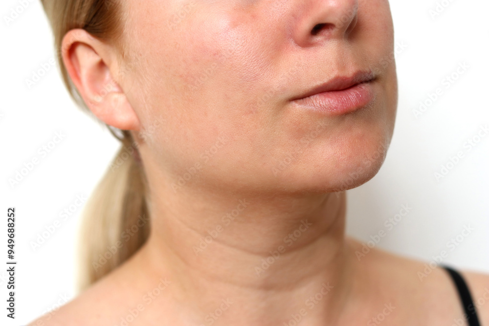 Obraz premium Close up of caucasian female face with healed acne skin