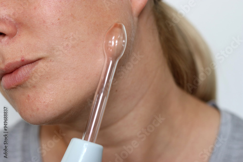 Close up of woman using a high frequency darsonval device on acne skin photo