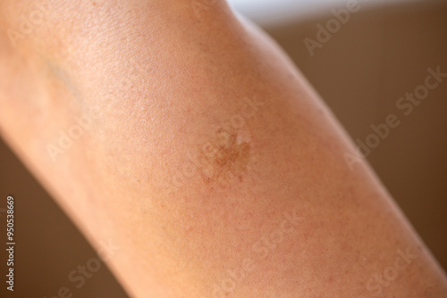  The woman has big scar from smallpox vaccine on her arm
