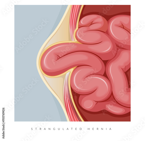 Strangulated Hernia -  Section of the Small Intestines - Stock Illustration