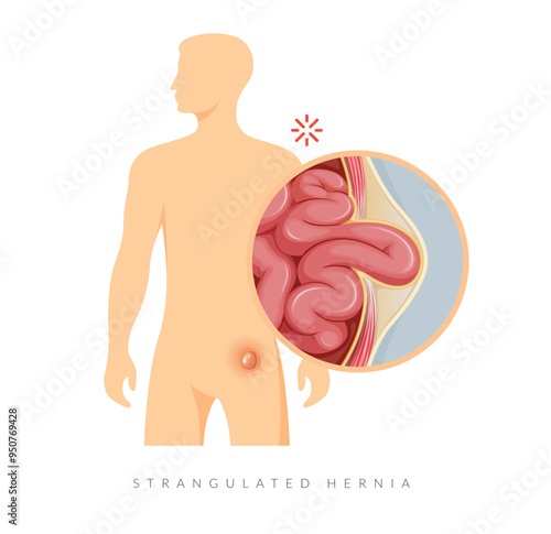 Strangulated Hernia -  Section of the Small Intestines - Stock Illustration