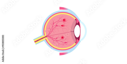 Diabetes related retinopathy