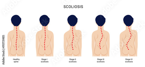 Scoliosis curvature of the spine four stages of disease development