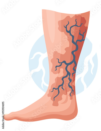 Stages or types of varicose veins development. Medical poster or disease infographic. Image of diseased legs. Vector illustration in flat style
