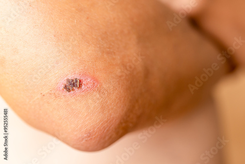 Tableau sur toile Close-up view of skin irritation on elbow showing redness and healing scab durin