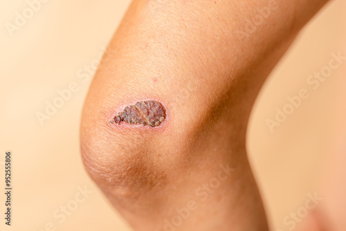Healing process of a scab on an elbow, captured in natural light, emphasizing the skin texture and details of the wound