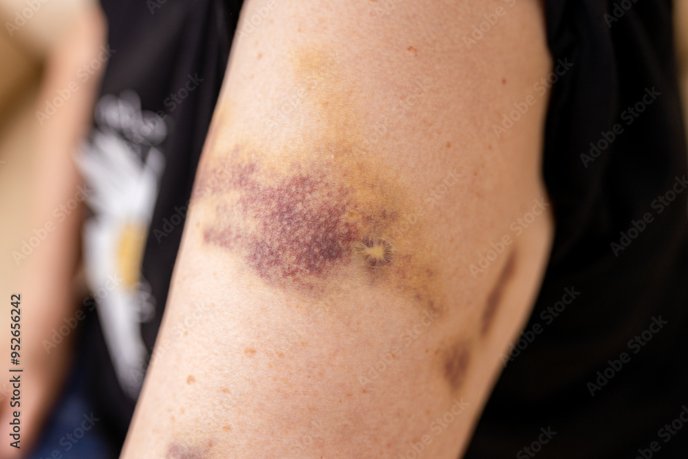 Fototapeta premium Large bruises on the arm of human from accident