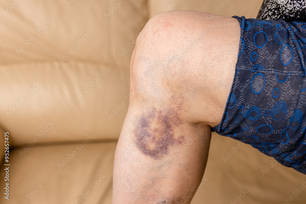 Close-up of a bruise on a woman's leg. A bruised leg Close-up of a bruise on a woman's leg. A bruised leg