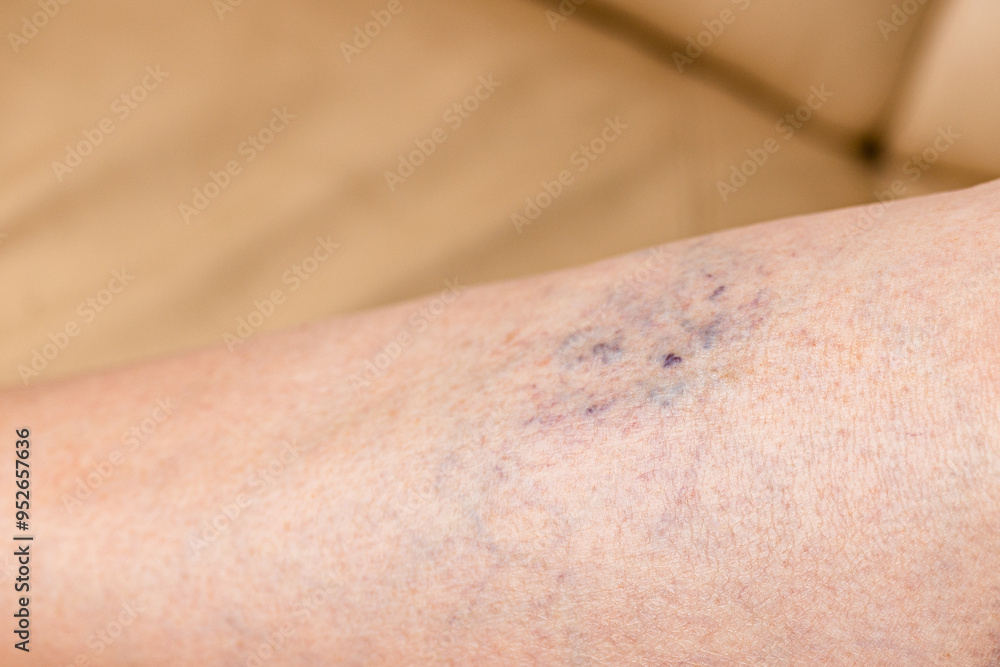 Close-up of a bruise on a woman's leg. A bruised leg Close-up of a bruise on a woman's leg. A bruised leg