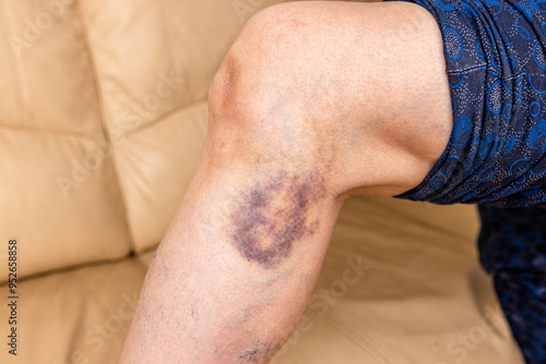 Foto Close-up of a bruise on a woman's leg. A bruised leg