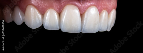 ceramic crowns and veneers