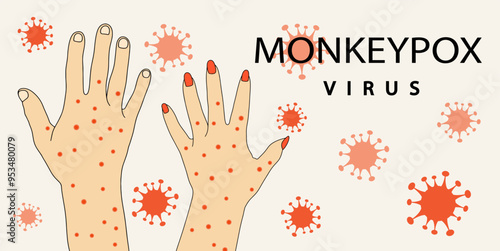 Monkeypox virus banner. Hands with monkeypox