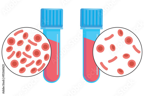 Anemia is a,blood lacks enough healthy red blood cells or hemoglobin, fatigue and weakness, iron deficiency, sickle cell disease, thalassemia.