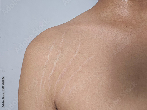 stretch marks on armpit skin area photo