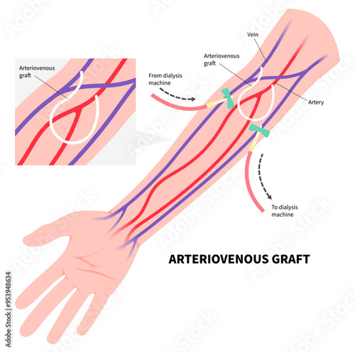 Vascular access surgery for kidney disease with intravenous injection tube on arm blood vessel in medical