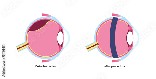 Scleral buckle procedure