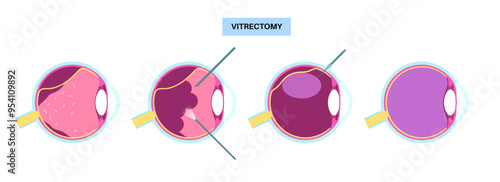 Vitrectomy surgical poster