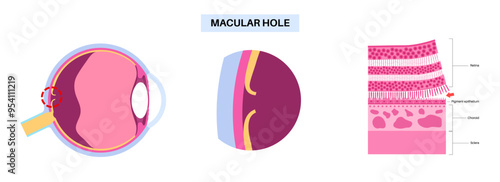 Macular hole disease