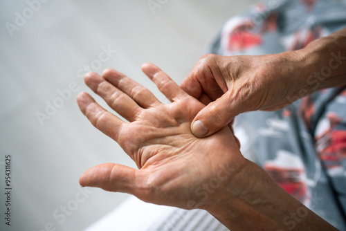 Foto Dupuytren contracture and protuberance on palm