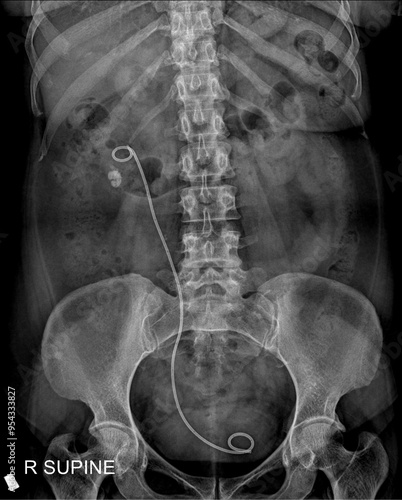 KUB X-ray Showing Properly Positioned Ureteral Stent with No Evidence of Obstruction photo