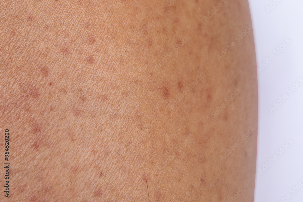 Fototapeta premium Skin presenting symptoms of eczema dermatitis