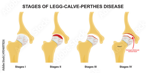 Fotografie Stages of legg calve perthes disease illustration