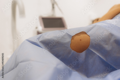 Принти на полотні the surgeon surgically removes a mole - surgical removal of a mole -