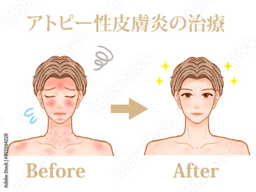 アトピー治療を受けた大人男性ビフォーアフターのイラスト素材