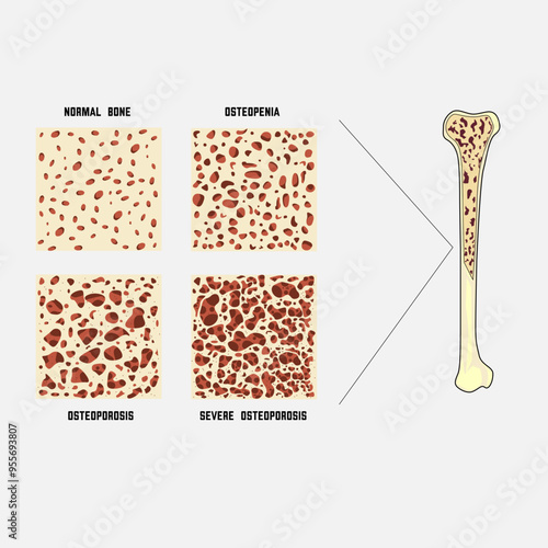 Deterioration of human bone, osteoporosis, osteopenia, severe osteoporosis.