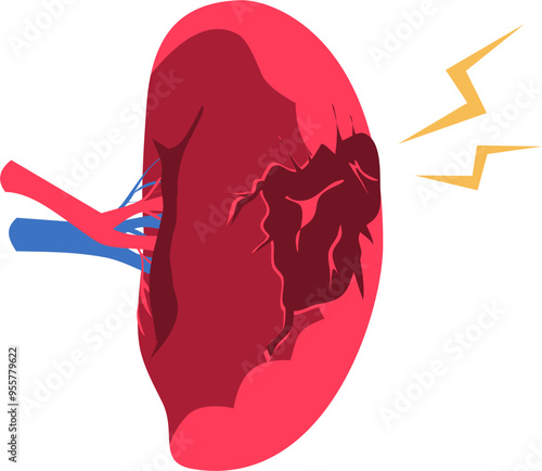 Spleen disease Illustration. Ruptured spleen.