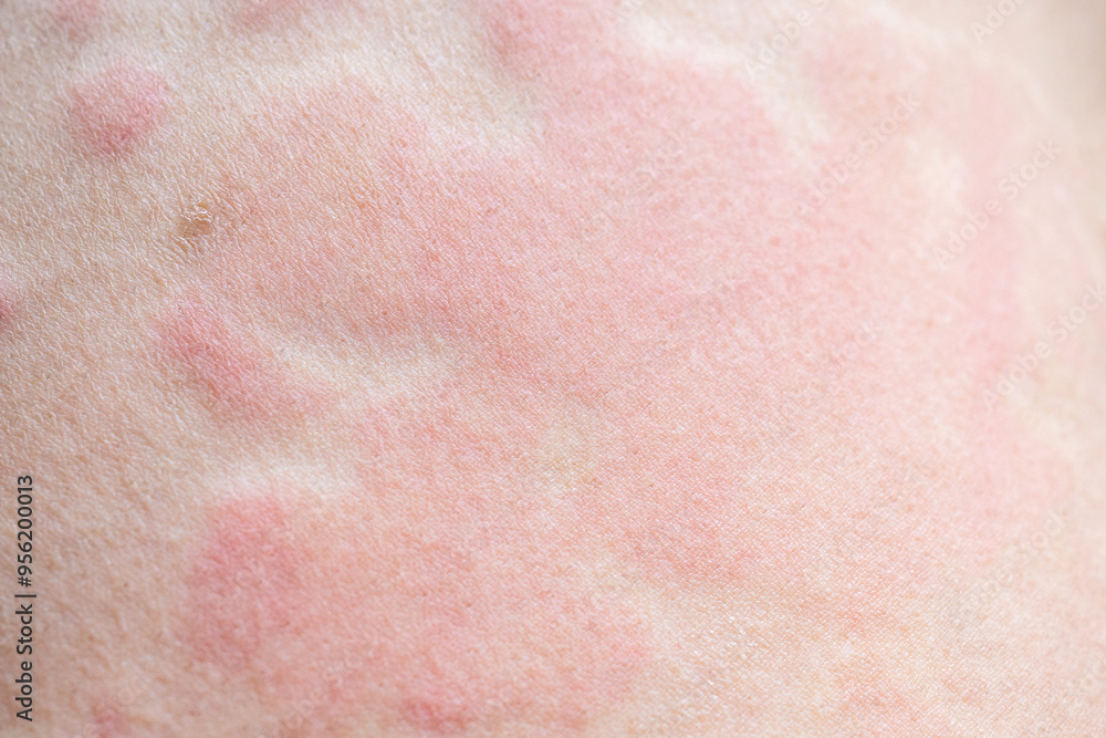 Fototapeta premium Skin allergy rash dermatitis texture close up