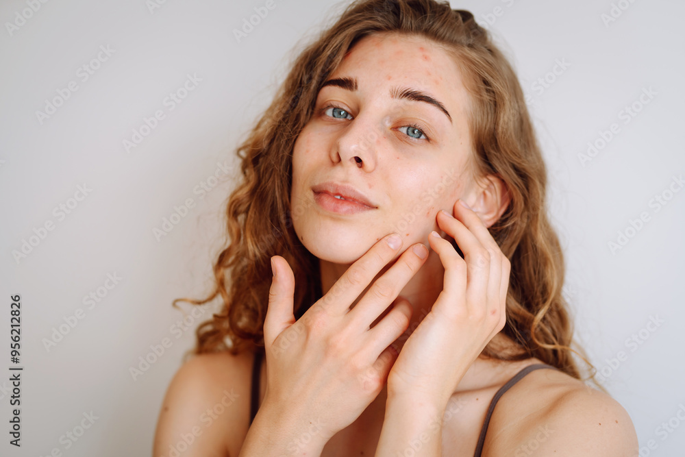 A young woman with curly hair and blue eyes gently touches her problem skin, displaying a calm expression. Pimples. Acne disease. Medicine and cosmetology. A young woman with curly hair and blue eyes gently touches her problem skin, displaying a calm expression. Pimples. Acne disease. Medicine and cosmetology.