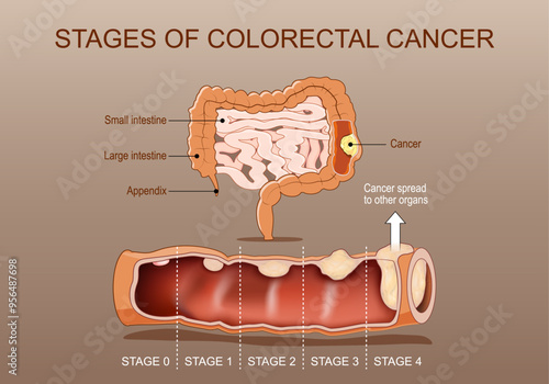 Stages of colorectal cancer