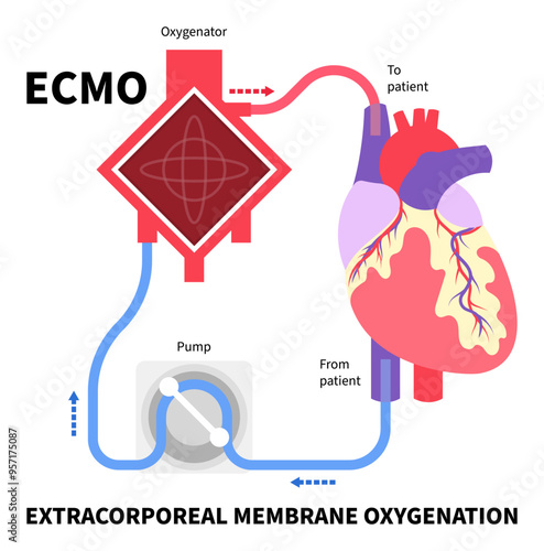 Heart bypass and Life support system with the Extracorporeal Membrane Oxygenation or ECMO for Respiratory failure illness patient