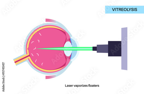 Vitreolysis laser treatment