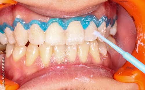 Foto A blue gel applied in arcs on the neck of the maxillary teeth to protect the gingival gum from the agressif dental bleaching process applied with a brush