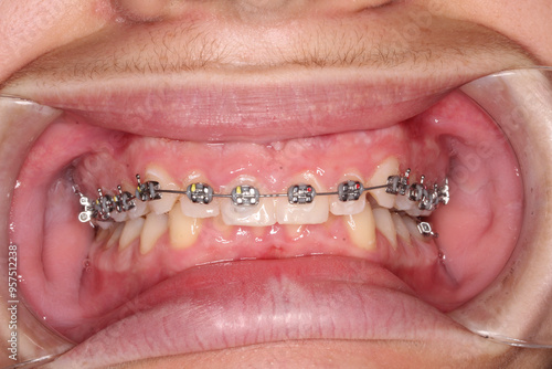 Frontal view of dental arches in overbiting occlusion with orthodontic braces, elastic O-ring ligatures, and metallic arch wire. Healthy gums, cheeks and lips retracted with a cheek retractor.