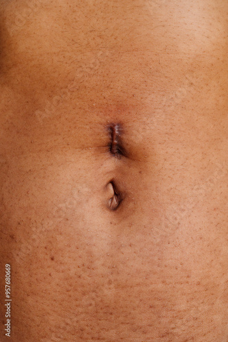 Abdomen with hernia scar on belly