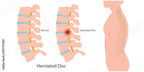 Herniated disc is also known as a slipped.