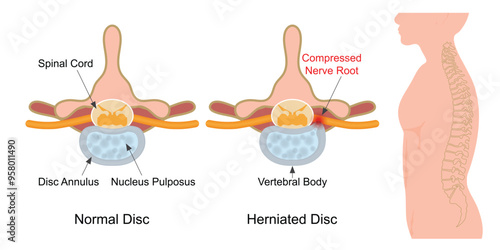 A slipped disc occurs when the outer covering of the disc tears.