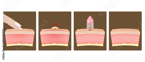 Process of squeezing acne with fingers until a large inflamed pimple forms, Acne scar treatment and skin after treatment Inflamed acne. The formation of acne scars.